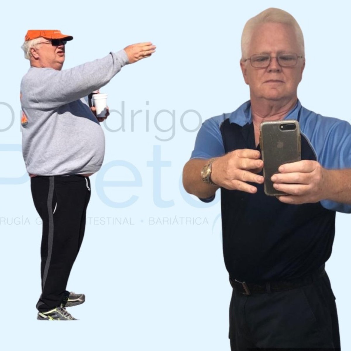 Результати до та після гастрошунтування в центрі доктора Родріго Прієто, Мексика