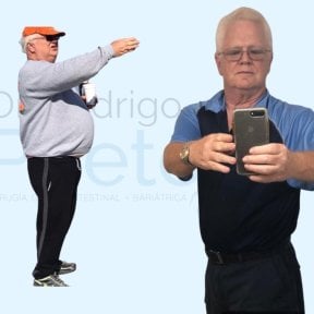 Результати до та після гастрошунтування в центрі доктора Родріго Прієто, Мексика