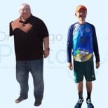 Результати до і після гастрошунтування в центрі доктора Родріго Прієто, Мексика