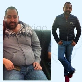 Vorher-nachher-Ergebnis Magenbypass bei Dr. Rodrigo Prieto Bariatric Surgery Center, Mexiko