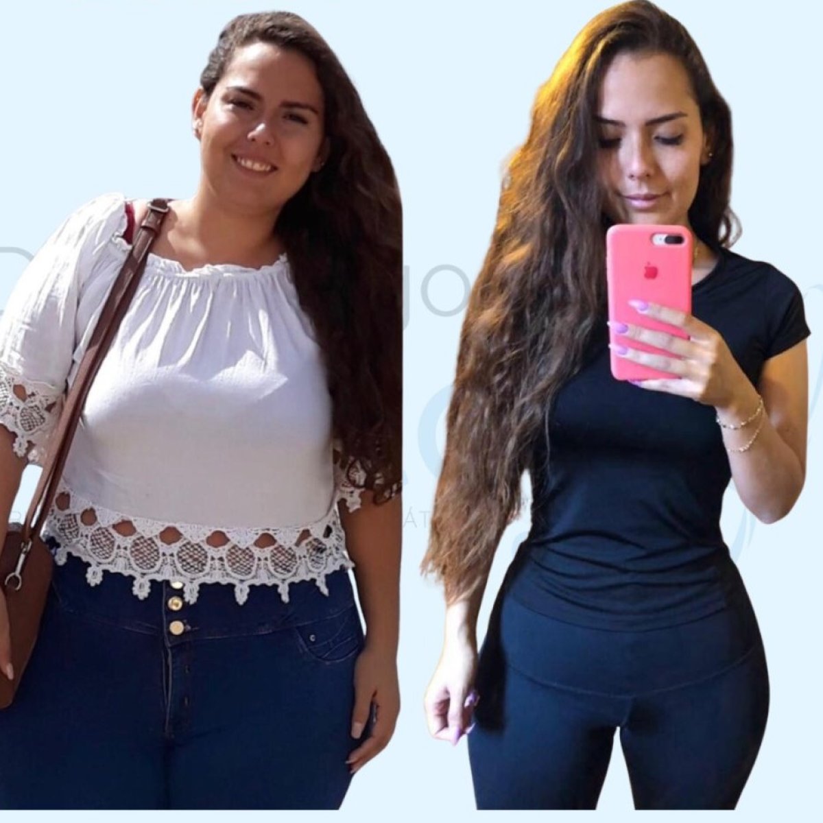 Результати до і після гастрошунтування в Dr. Rodrigo Prieto Bariatric Center Мексика