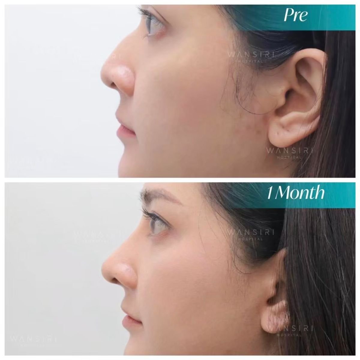 Resultados antes y después de rinoplastia de punta en Wansiri Hospital tras 1 mes