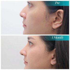 Before and after tip rhinoplasty results at Wansiri Hospital, nose reshaping after 1 month