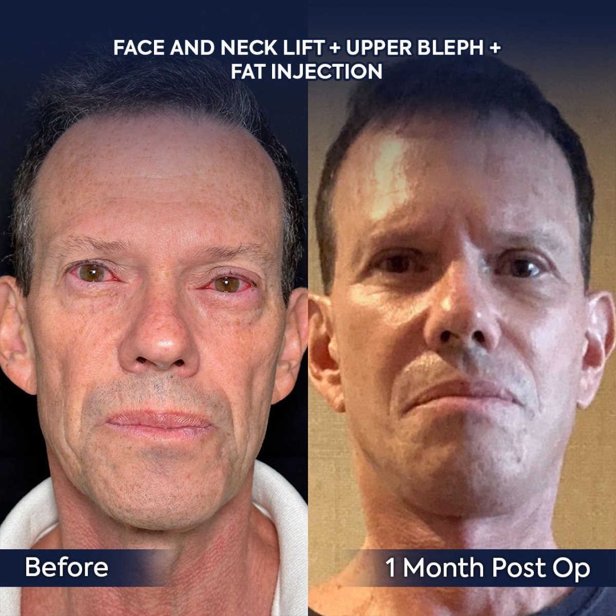 نتائج شد الوجه والرقبة وجفن علوي قبل وبعد في عيادة Dr. Safa Manav