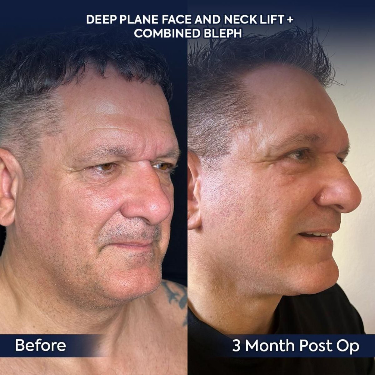 نتائج شد الوجه والرقبة قبل وبعد في عيادة Dr. Safa Manav بعد 3 أشهر