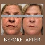 Before and after Morpheus8 skin tightening results at ID Clinic Bangkok, improved facial firmness