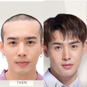 Before and after hair transplant at ID Clinic Bangkok – restored hairline and fuller hair result