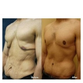 Результати абдомінопластики для чоловіків в ID Clinic Bangkok, покращений контур живота