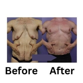 Результати абдомінопластики у чоловіка в ID Clinic Bangkok – покращений контур живота