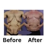 Результати абдомінопластики у чоловіка в ID Clinic Bangkok – покращений контур живота