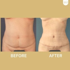 Результати абдомінопластики до і після в ID Clinic Bangkok, покращений контур живота