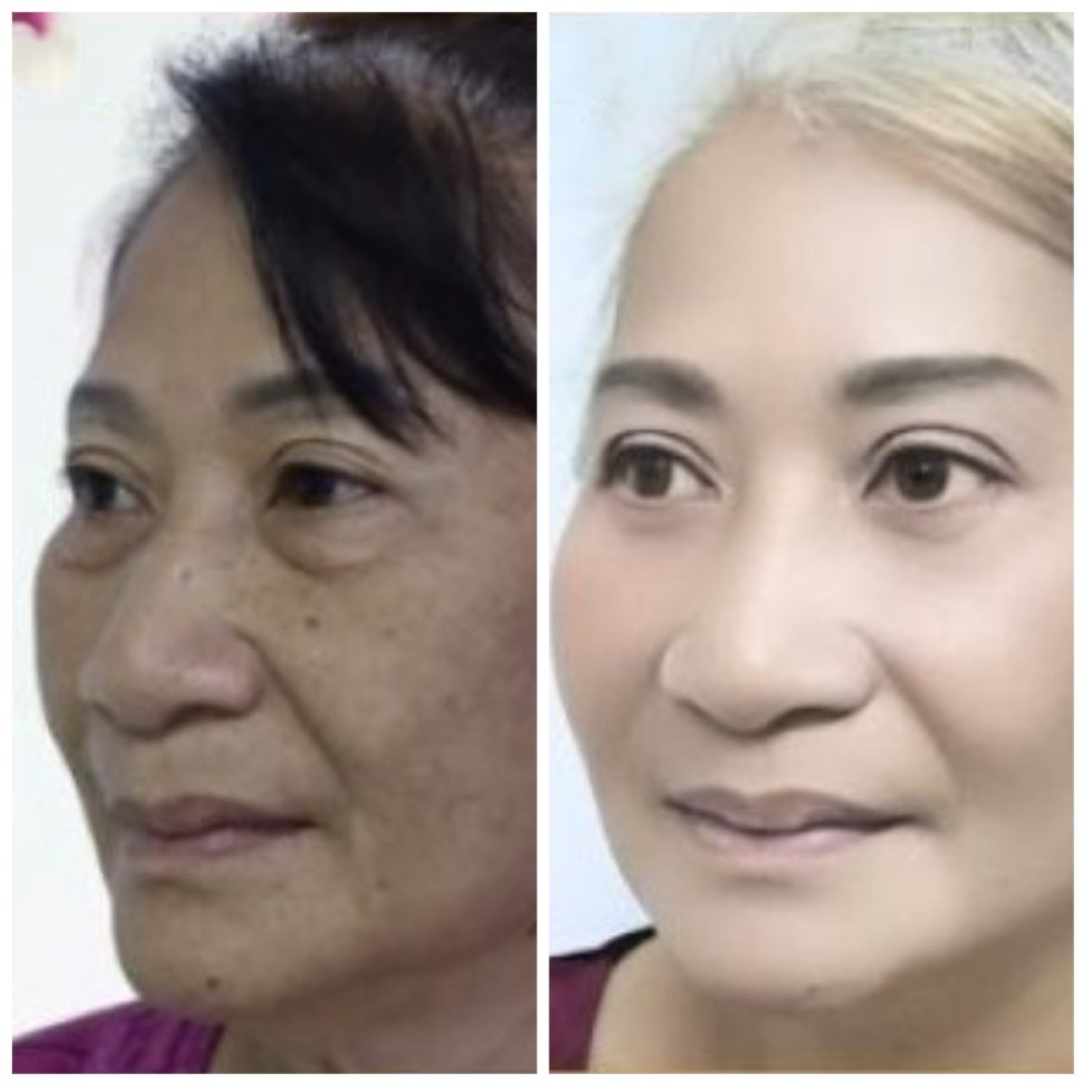Facelift before and after results at Asia Cosmetic Hospital, visible facial rejuvenation effect