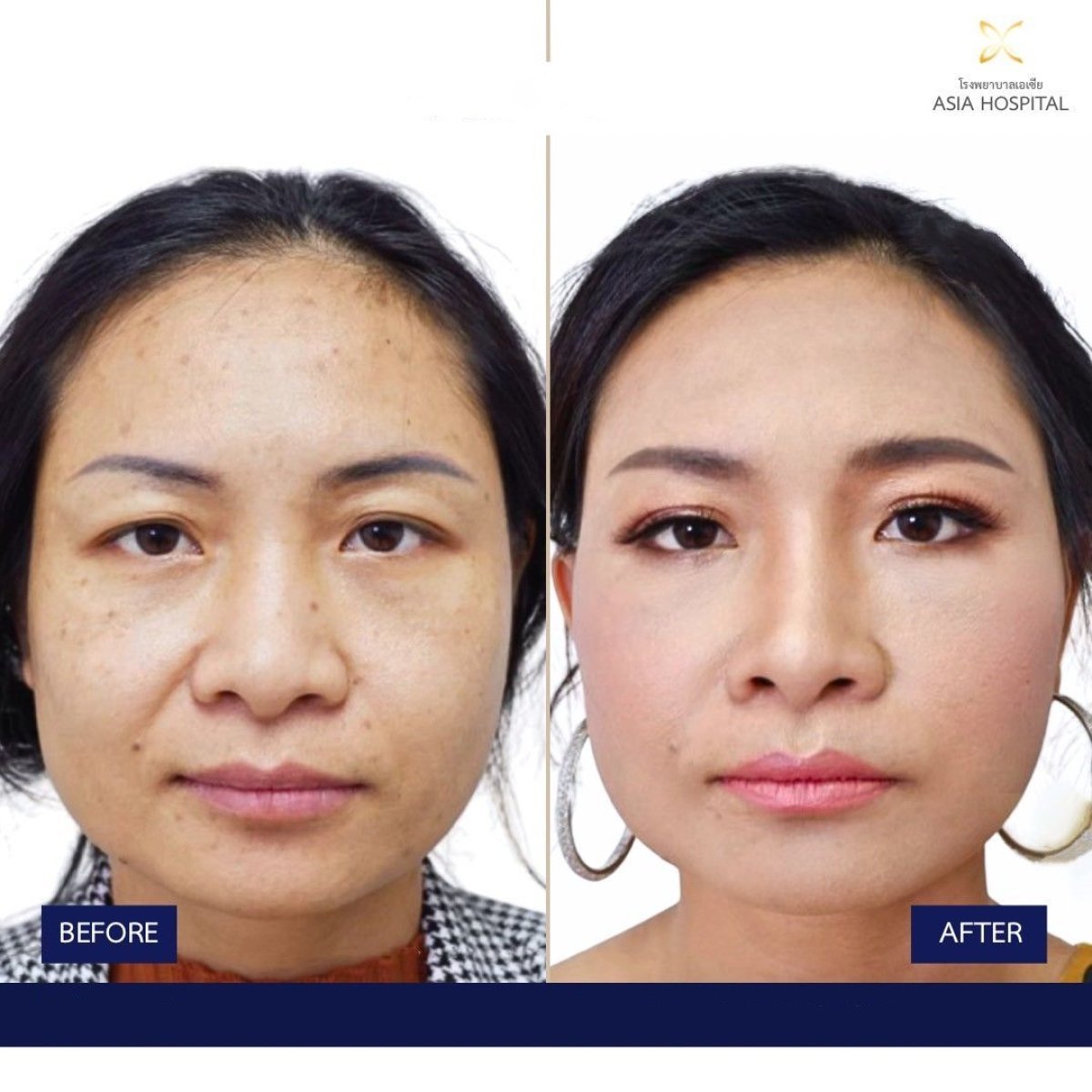 Facelift before and after results at Asia Cosmetic Hospital, facial rejuvenation and smoother skin