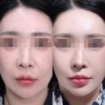 Facial feminization surgery before and after results at Returning Plastic Surgery, refined features