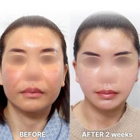 Facial feminization surgery before and after results at Returning Plastic Surgery, 2 weeks post-op
