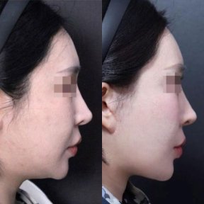 Before and after facial feminization surgery results at Returning Plastic Surgery, profile view
