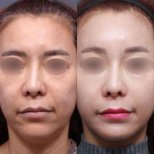 Facial feminization surgery before and after results at Returning Plastic Surgery, softer features