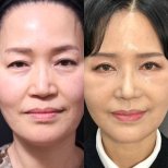 Facial feminization surgery before and after results at Returning Plastic Surgery, softer features