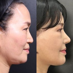 Before and after facial feminization surgery results at Returning Plastic Surgery, refined jawline