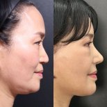 Before and after facial feminization surgery results at Returning Plastic Surgery, refined jawline