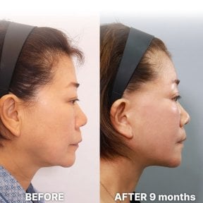 Facial feminization surgery before and after results at Returning Plastic Surgery, 9 months post-op