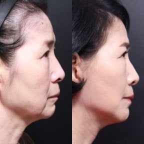 Before and after facial feminization surgery results at Returning Plastic Surgery, jawline refined