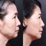 Before and after facial feminization surgery results at Returning Plastic Surgery, jawline refined