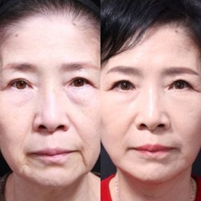 Facial feminization surgery before and after results at Returning Plastic Surgery, youthful look