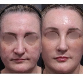 Facial feminization surgery before and after results at Returning Plastic Surgery, softer features