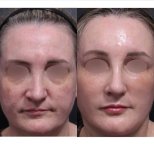 Facial feminization surgery before and after results at Returning Plastic Surgery, softer features
