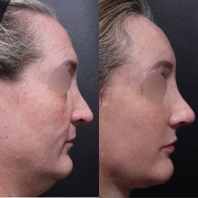 Before and after facial feminization surgery results at Returning Plastic Surgery, refined profile