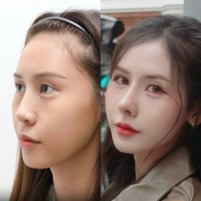 Before and after tip rhinoplasty results at Wansiri Hospital, refined nose shape improvement