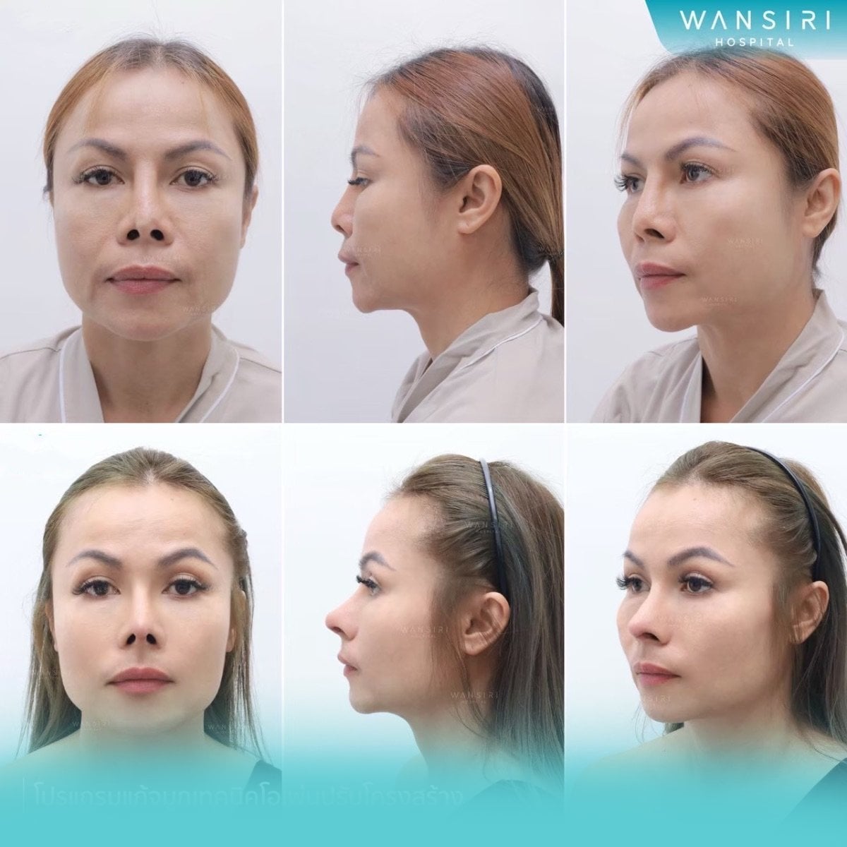 Resultados antes y después de rinoplastia de punta en Wansiri Hospital, mejora nasal