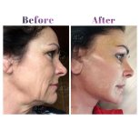 Vorher-nachher-Ergebnis Facelift bei Db'est Clinic, sichtbare Hautverjüngung