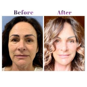 Vorher-nachher-Ergebnis der Blepharoplastik bei Db'est Clinic, Lidkorrektur für jüngeres Aussehen