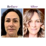 Vorher-nachher-Ergebnis der Blepharoplastik bei Db'est Clinic, Lidkorrektur für jüngeres Aussehen