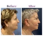 Vorher-nachher-Ergebnis Facelifting bei Db'est Clinic, sichtbare Verjüngung und Kontur