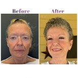 Vorher-nachher-Ergebnis der Blepharoplastik bei Db'est Clinic, Lidkorrektur für jüngeres Aussehen