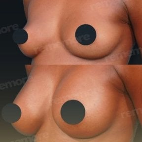 Before and after breast implants with lift at Memorial Şişli Hospital, enhanced breast shape result