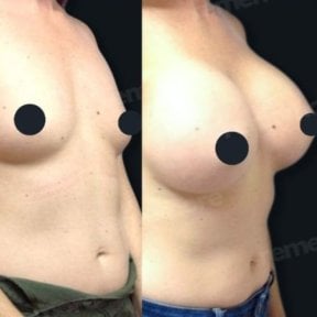 Before and after breast implants with lift at Memorial Şişli Hospital, enhanced breast shape result