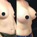 Before and after breast implants with lift at Memorial Şişli Hospital, enhanced breast shape result