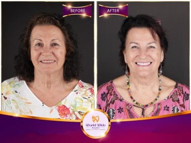 Before and after All-on-4 dental implants result at Worldwide Dental & Plastic Surgery Hospital