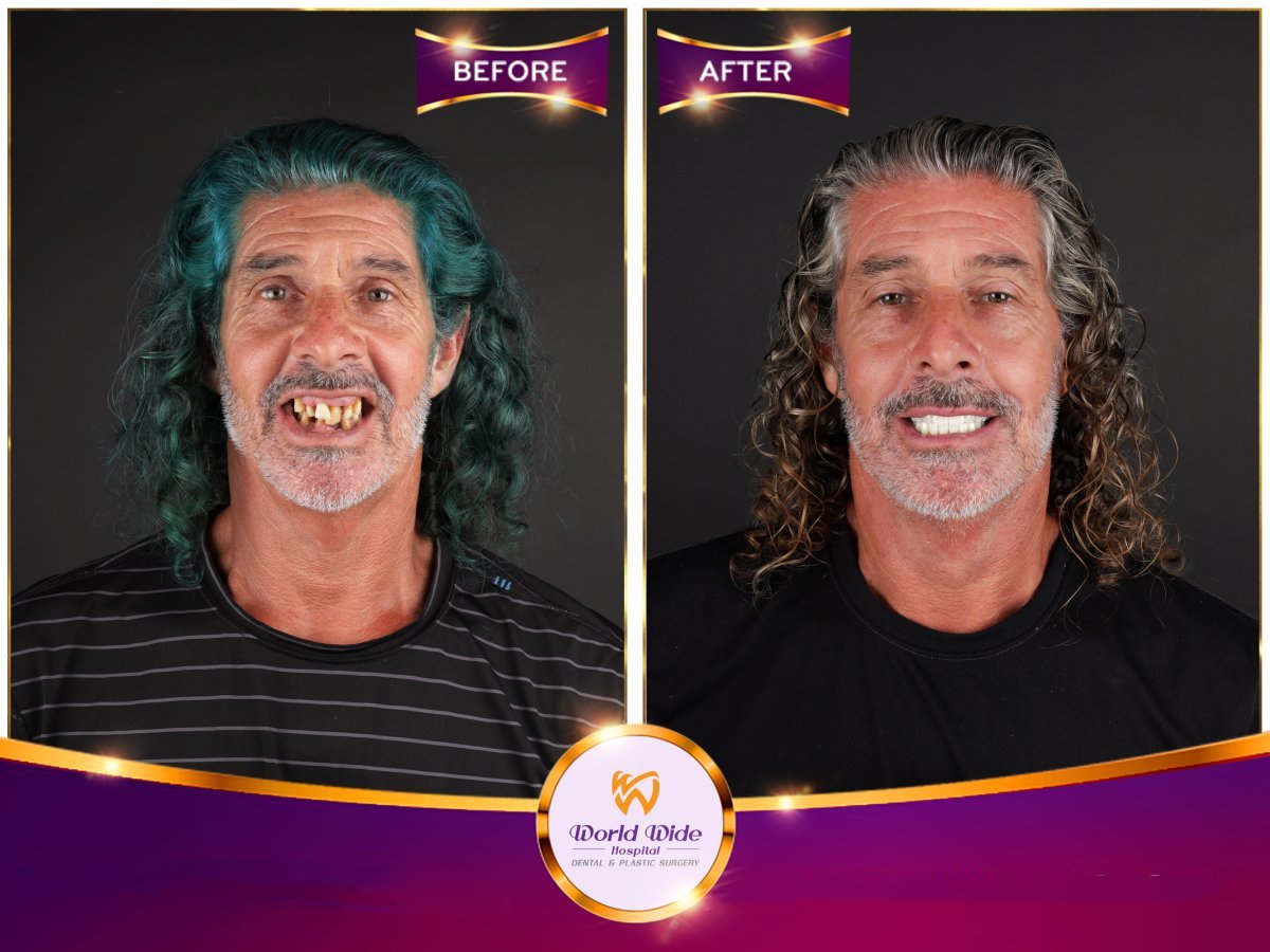 نتيجة زراعة الأسنان All-on-4 قبل وبعد في مستشفى Worldwide Dental & Plastic Surgery