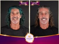 Before and after All-on-4 dental implants result at Worldwide Dental & Plastic Surgery Hospital