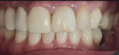 Resultado de implante dental en SoftDentalCare Clinic: restauración de dientes frontales
