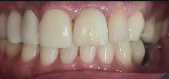 Resultado de implante dental en SoftDentalCare Clinic: restauración de dientes frontales