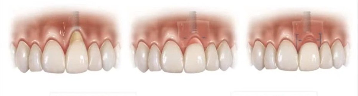 Étapes de l’implant dentaire à SoftDentalCare Clinic – résultats de restauration étape par étape