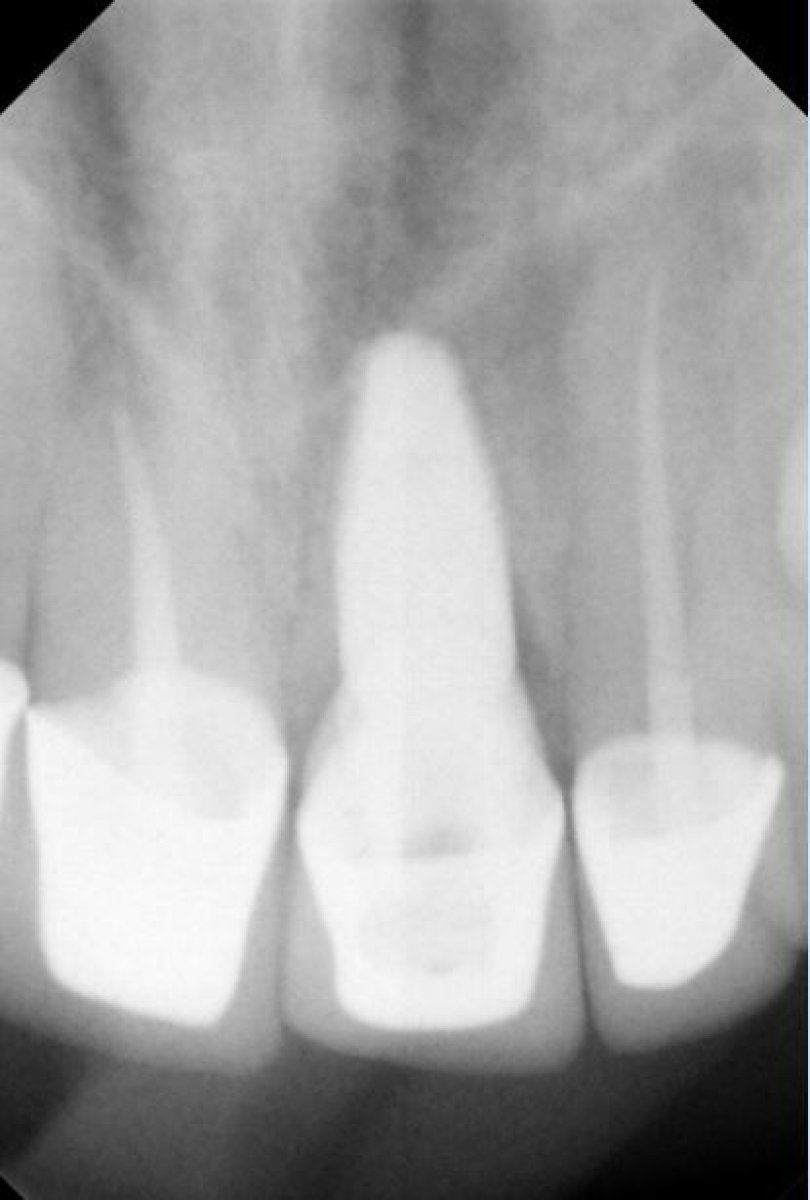 Radiographie d’implant dentaire après procédure à SoftDentalCare Clinic, restauration visible
