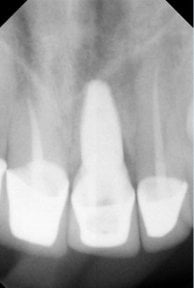 Radiografía de implante dental tras el procedimiento en SoftDentalCare Clinic, restauración visible