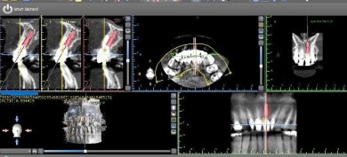Resultado de planificación de implante dental con imagen 3D en SoftDentalCare Clinic